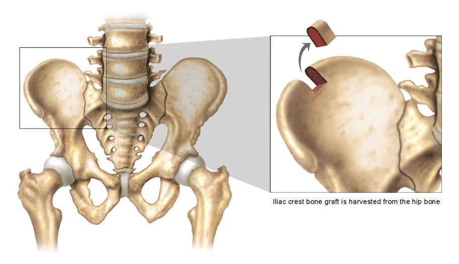 Supply Chain Guide To Spinal Biologics - Bioventus Surgical